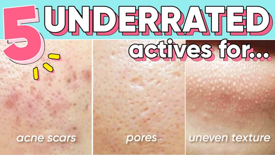 5 Ingredients You Need for Pores, Hyperpigmentation, Acne Marks